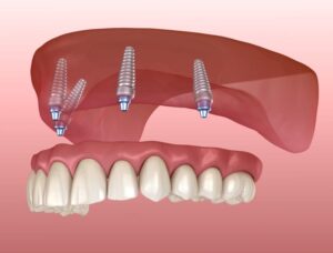 Tipos de prótese dentária